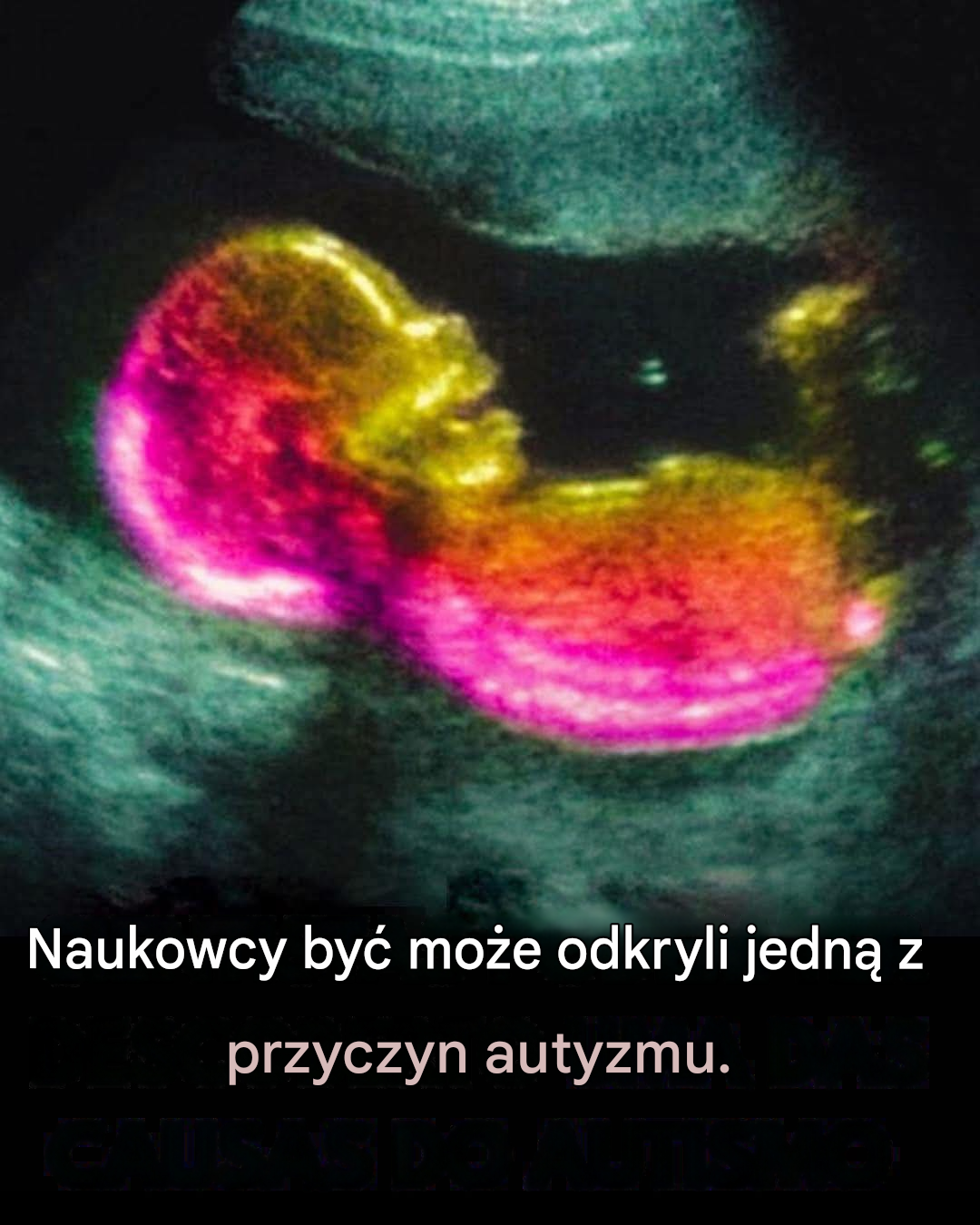 Czy to prawda, że ​​autyzm częściowo ma swoje źródło w łonie matki?