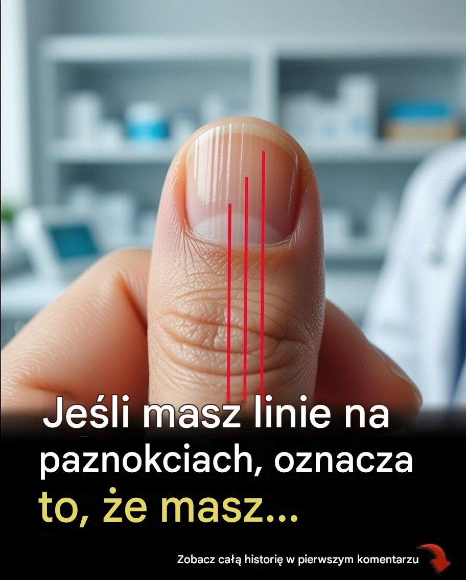 Linie na paznokciach mogą świadczyć o niedoborach żywieniowych lub innych problemach zdrowotnych.