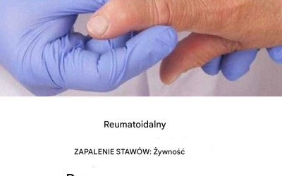 Życie z reumatoidalnym zapaleniem stawów: codzienne wyzwania