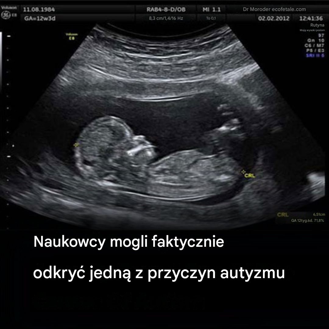 Naukowcy mogli faktycznie odkryć jedną z przyczyn autyzmu