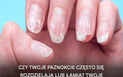 Białe, prążkowane i łamliwe paznokcie: co to może oznaczać?